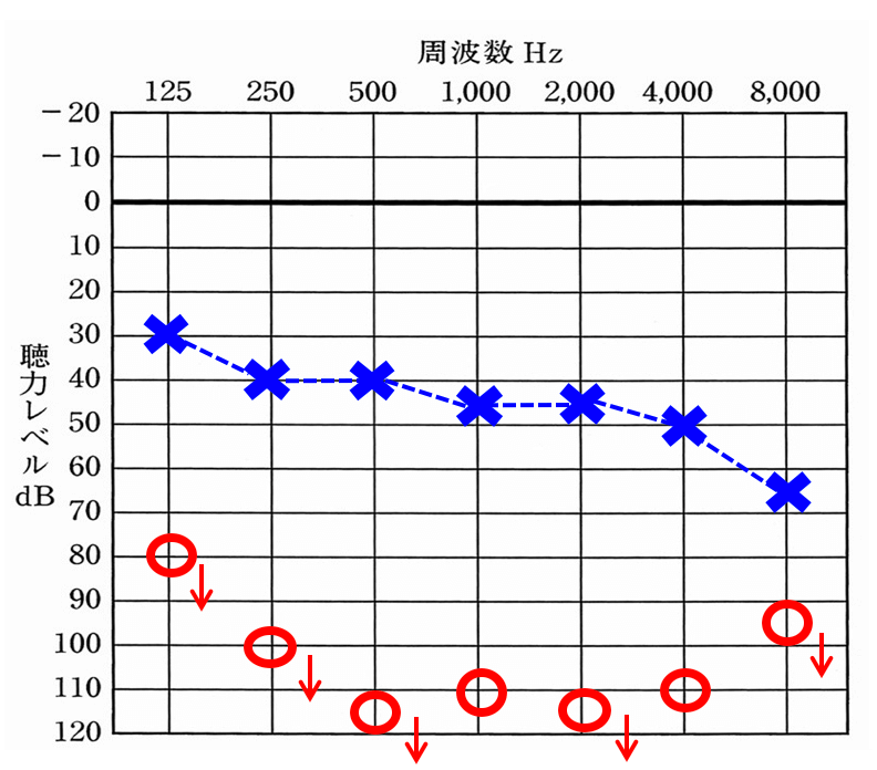 片耳のみ聴力低下が大きいケース。