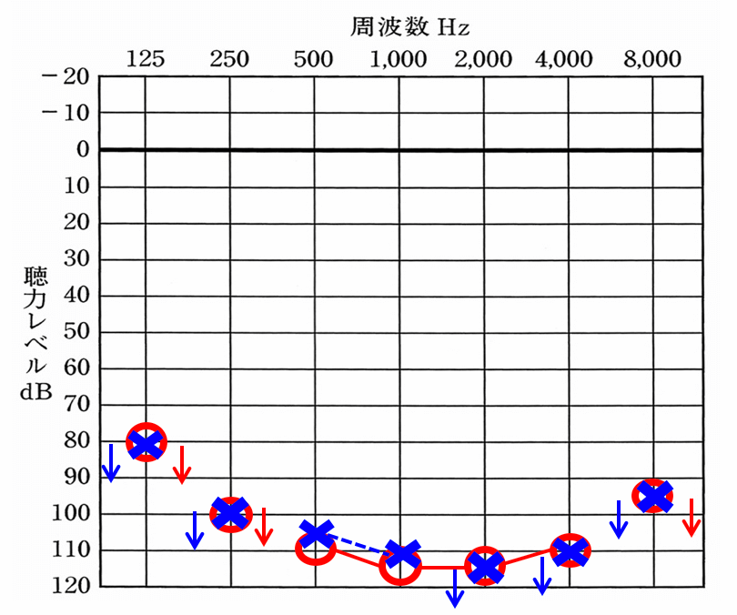 両耳ともかなり聴力が重いケース。