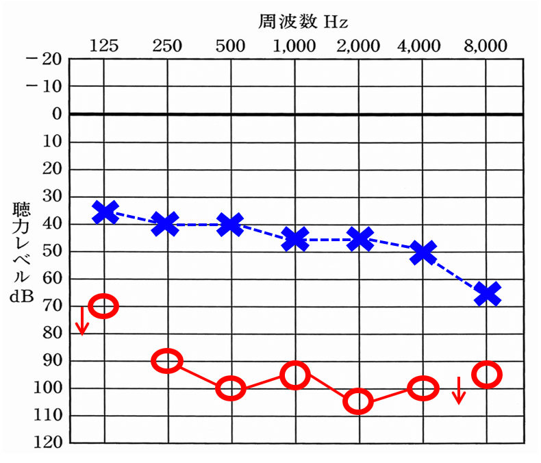 補聴器は、様々な要素により、効果が異なる。その一つが聴力だ。聴力が重い耳は、軽い耳よりも効果は、必ず薄くなる。