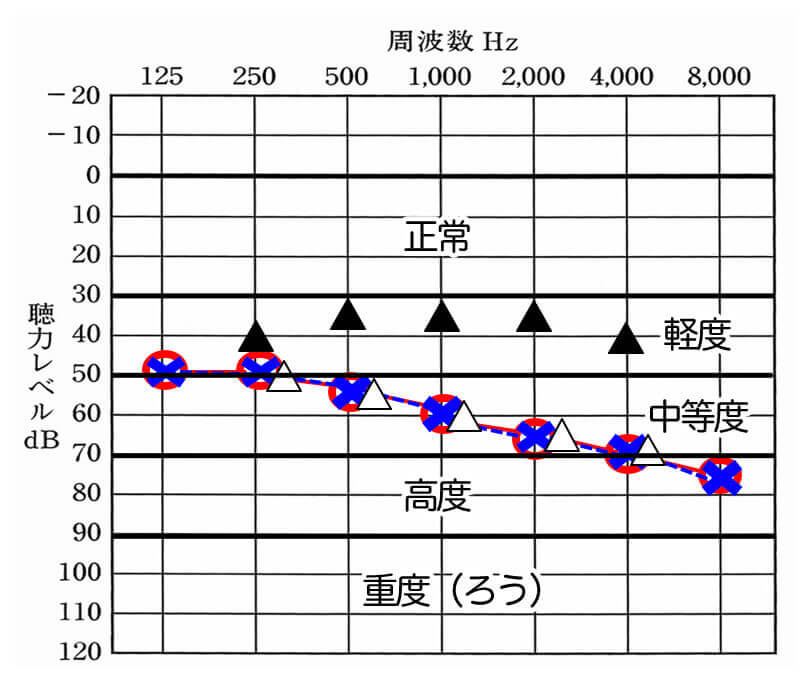 このような図があった場合は、補聴器を装用することで、軽度難聴くらいまでは、改善できたことがわかる。