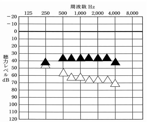 これは、音場閾値測定で調べた数値。補聴器には、補聴器使用時の状態を調べられるものがあり、その数値が上にくると上に来るほど、聞こえやすくなる。その数値がちゃんと聴力に対して必要な部分まで改善しているのかどうかが、聞こえのベースになる。ここが低いと効果は、下がる。