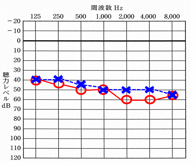 聴力図。主にオージオグラムと呼ばれ、耳の状態を把握するために測定を行う。