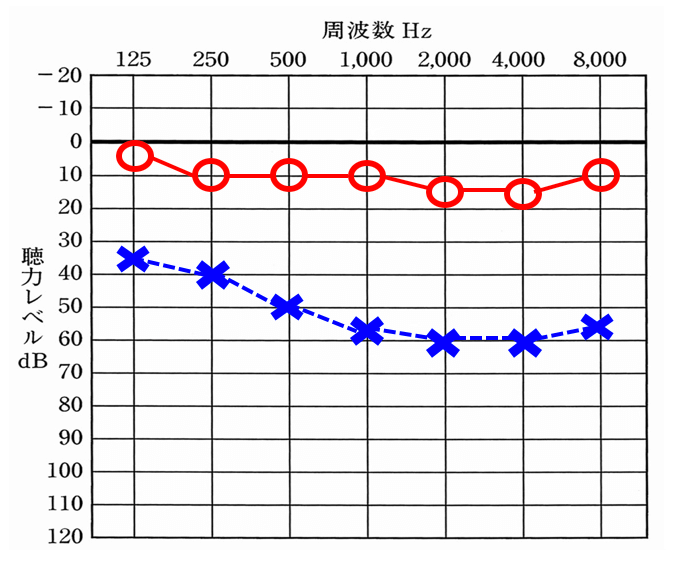 片耳が正常で、片耳が中等度難聴くらいだと、補聴器で聞こえない側を補った方が改善度は、基本的にはよくなる。