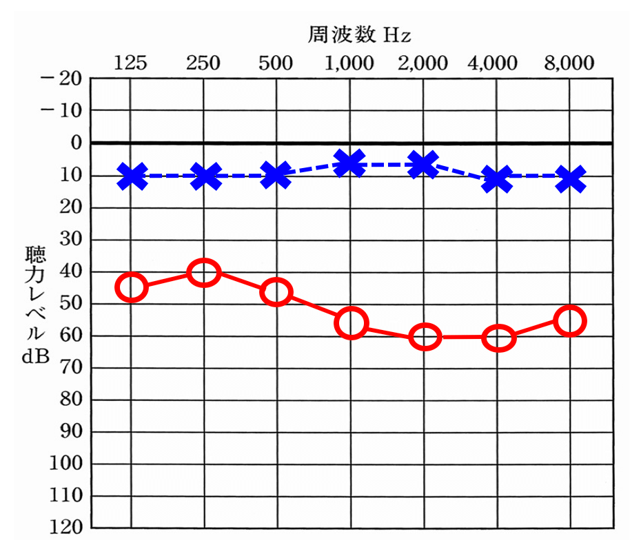こちらは、左耳が正常。右耳が効きにくい状態になる。
