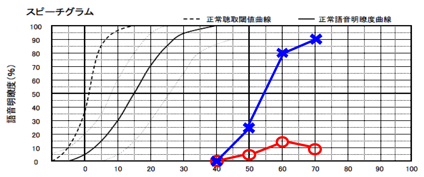 片耳のみ明瞭度が低いケースの例。こちらは、聴力関係なしに明瞭度が低いケースとなる。