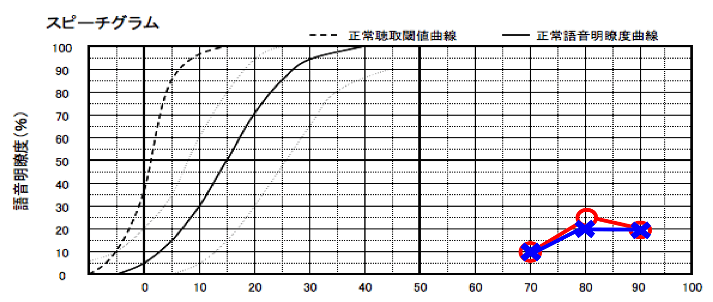 両耳とも明瞭度が低いケース。
