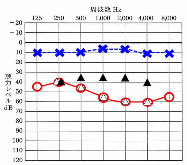 ▲は補聴器を装用した状態、△は、補聴器を装用していない状態。補聴器の世界には、補聴器の効果を可視化するものがある。それを使うことで、聴力ごとの効果を割り出すことができ、それにより、どのくらいの聴力であれば、補聴器の方が効果が高いのかもわかる。