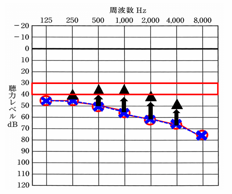 補聴器を装用して改善できる数値は、おおよそ決まっている。だいたい、35dBくらいまで改善でき、良いケースは、30dBくらい行くケースもある。