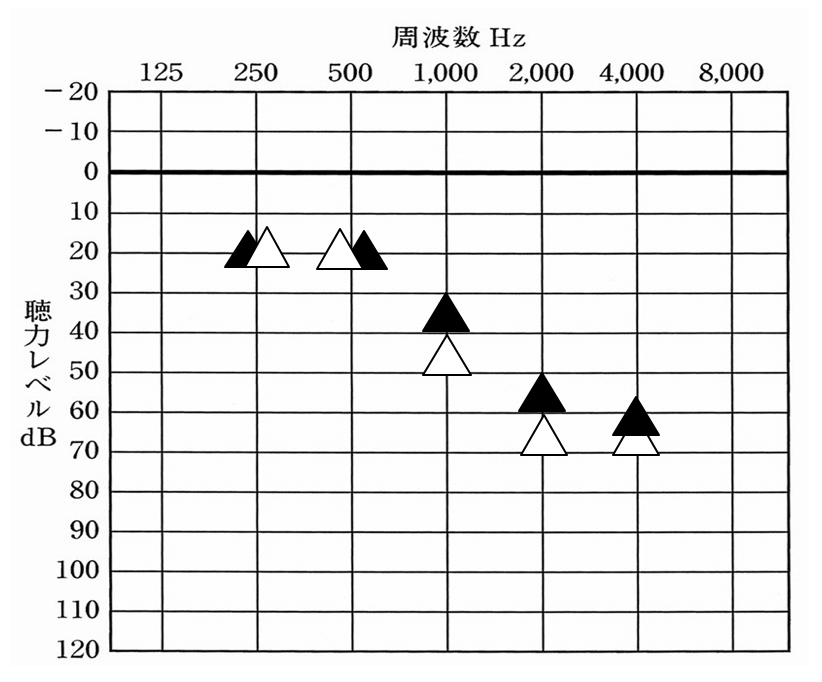 上記のケース、同様。補聴器を装用した状態で測定したデータ。こちらは、1000Hzが改善されることにより、効果に関して感じやすくなった例になる。