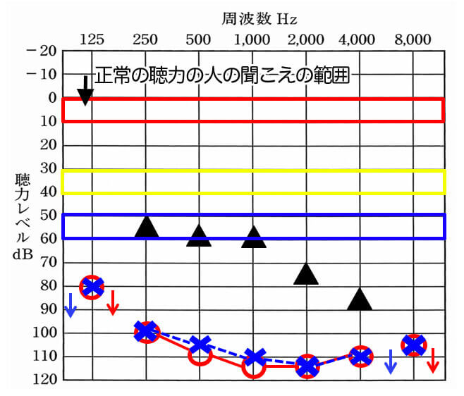 数値の意味に関しては、この通り。ある程度、聴覚のみで理解する場合、音だけで評価するとこのようになる。黄色まで聞こえを改善できるとそれなりに良くなるのだが、残念ながら重度難聴の方は、青の範囲内までしか改善できないことが大半になる。