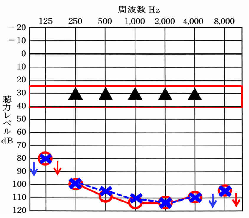 人工内耳の改善範囲。補聴器よりも大きく上回り、補聴器では決してたどり着けない部分まで改善させることができるようになった。健聴の方の聴力には、及ばないが、補聴器より、改善値は高くなる。