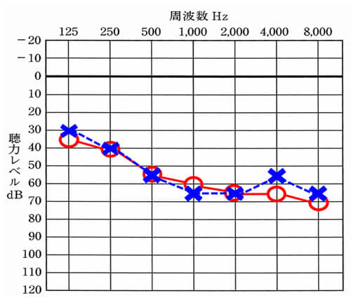 私の聴力。典型的な中等度難聴の数値が、こちら。