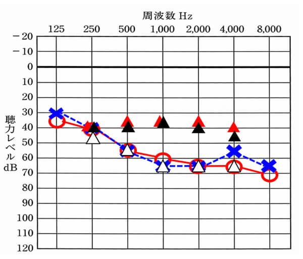 補聴器の聞こえは、▲になる。この▲の位置が上にくるとくるほど、聞きやすさは、改善しやすい。そして、ほとんどの機器は、調整して、改善させる、この機能が付いているため、どれも改善できるようになっている。