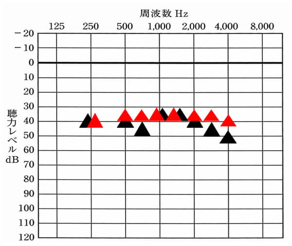 これは、音場閾値測定で測定した数値。▲が補聴器を使用している状態。赤い△が改善目標値だとすると、このように数値化される。すると、どの周波数が足りていないのか。逆に良い状態まできているのかもわかるようになる。補聴器は、可視化すると、状況が一気にわかりやすくなる。