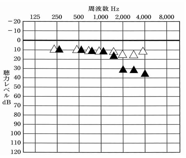クロス補聴器を装用した状態▲と補聴器なしの状態△。実際にどのくらい聞こえにくくなるのか。それを可視化するとだいたいこんな感じになることが多い。低い音は軽減されないが、高域が結構低下する。