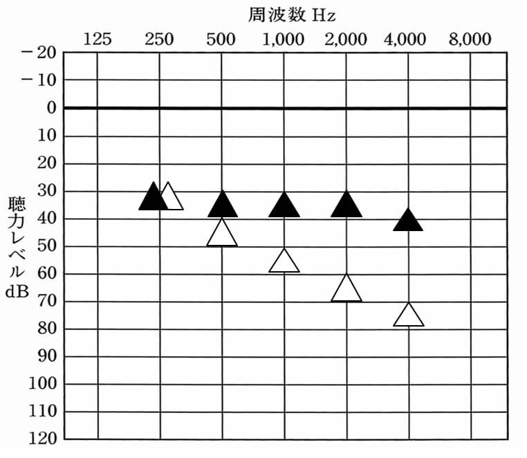基本的にオージオグラムと見方は同じ。数値が上にあるとあるほど聞こえやすくなる。
