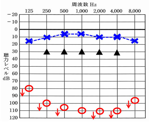 人工内耳の改善例。重度難聴の方がここまで改善できるのは驚きだが、数値上で比較するとクロスには、及ばない。この部分がどう影響を与えるか。