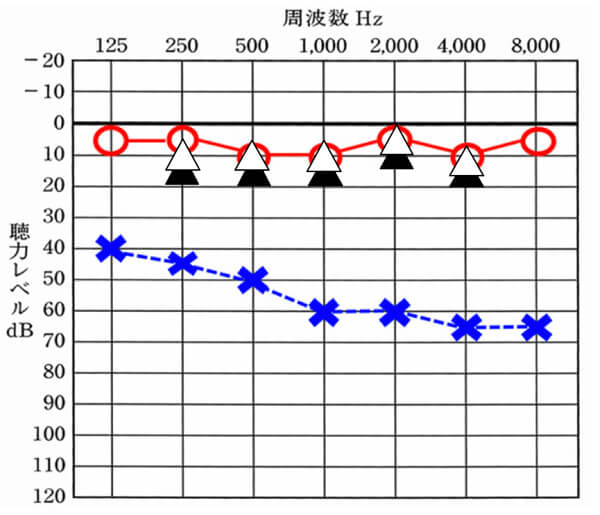 クロス補聴器の場合は、だいたいこのくらいは改善する、聞こえる耳側につけているため、数値としては、このように改善度が高くなりやすいところに注意。