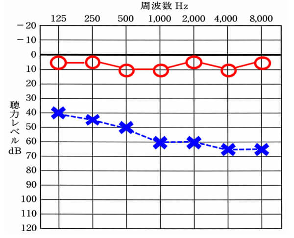 今回の例。こちらを例に出したのは、人工内耳の改善数値とこのような難聴の方の補聴器での改善数値が似ているため。