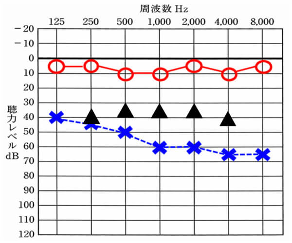 まず補聴器を装用した時の聞こえの効果としては、だいたいこのようになる。良いケースは、35dBのところが30dBまで改善することもある。
