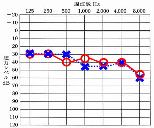 比較的、軽度に該当する聴力。聴力レベルが軽度でも、聞こえにくいところは、聞こえにくいため、困っている人も意外に多い聴力でもある。日々の生活状況によって評価が異なる聴力。