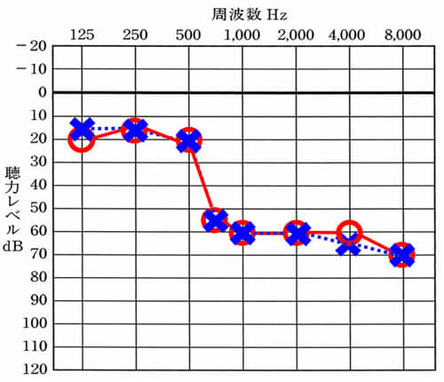 高音急墜型の聴力。この聴力には、軽度、中等度、重度があるが、その中等度クラスの場合に当てはまる。