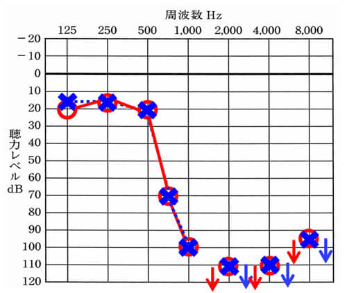 高音急墜型の重度のケース。高い音がほとんど聞こえず、改善もまだ難しい状態になる。実際につけてみて改善の余地があるのかを調べながら改善して行くのが必須なケース。