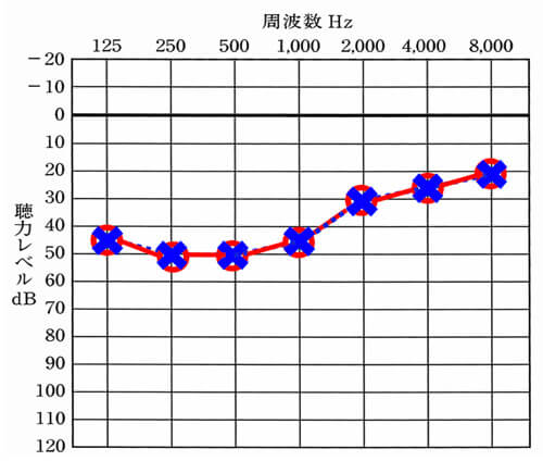 低音障害の聴力図。低い音が聞こえず、音が高くなるとなるほど、聞こえやすくなる。