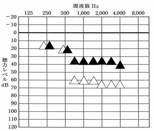 △は、補聴器なしの状態。▲は、補聴器をつけた時に達成したい目標値。ここまで目指せると、聞こえに関しては、改善しやすくなる。もちろん、耳が治る訳ではないため、聞きにくいところは出てくるが、状況に関しては、よりよくなりやすい、。