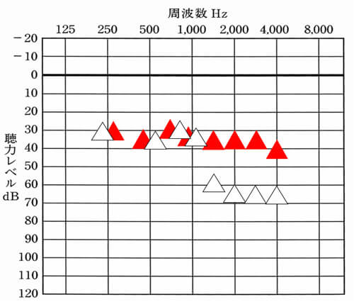 補聴器の場合、ある程度、どこまで改善すれば良いのかの数値がある。それと比較することで、現状を把握することができる。