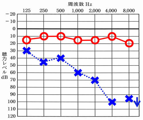 低域がある程度聞こえている場合(125〜750Hzが60dB未満)、耳を塞ぐと自分の声がこもったり、響いたりする感覚を感じやすい、これは、軽いと軽いほど感じやすい感覚になる。