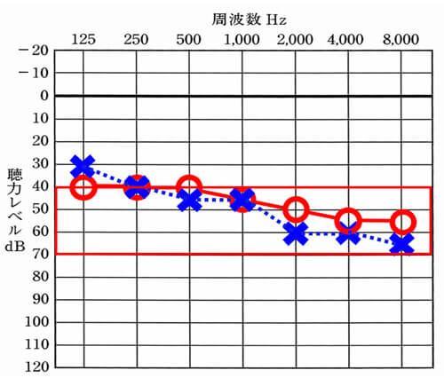 片耳難聴の場合における補聴器の判断は、約70dBより軽いこと。それ以上、重くなると、クロス補聴器の方が改善がよくなる傾向がある。