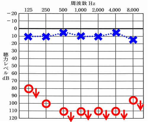 突発性難聴により、聴力が低下した場合、いくつか考えられるパターンの一つ。全く聞こえないケースもよくみる。