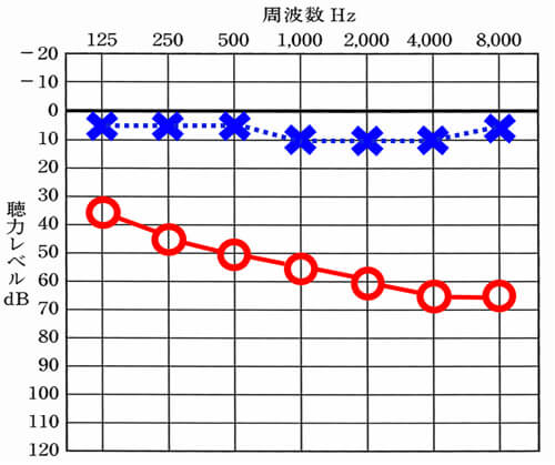 突発性難聴になっても明瞭度および、聴力低下の量がそこまで重くならないケースもある。
