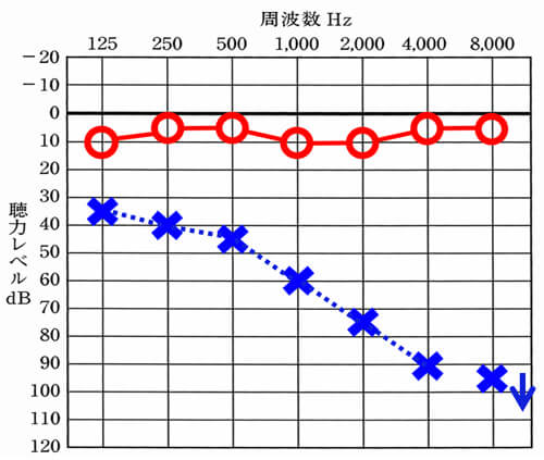 歪んで音が聞こえるケースは、低い音は聞こえているが、高い音になるにつれ、大きく聴力低下しているケースに見ることがある。