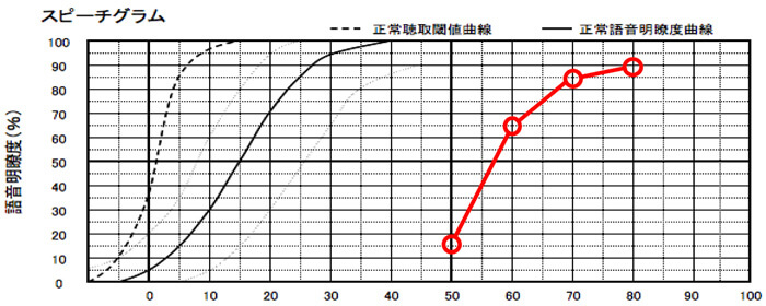 軽度〜中等度難聴の方の明瞭度を調べてみると意外にあるケースがある。その場合は、補聴器でなるべく聞きにくくしていった方が良いケースが多い。ただ、聴力やこのパーセンテージによっては、クロスの方が良いケースもあるので、二つとも試してから決めるとより良くなったりする。