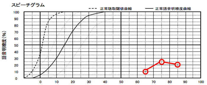 明瞭度が低い場合は、クロス補聴器で補うのが良い。ただ、50%、60%くらいの場合、クロス補聴器か、一般の補聴器か、どちらが良いか、簡単でも良いので、試して見るとより判断はしやすくなる。