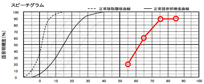 明瞭度が良い場合は、そのまま補聴器を装用して聞こえを補う方が良いケースが多い。ただ、明瞭度が60%、70%くらいだと、クロスの方が改善できるというケースもあった。実際には、二つとも試してみて効果を見るのが良い方法にはなる。