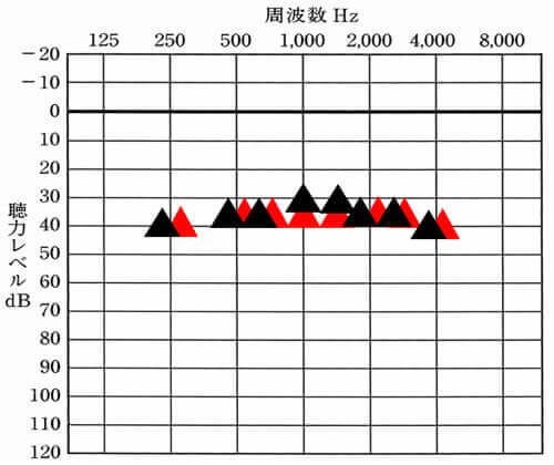 補聴器には、主に改善させる目標値が存在する。その目標値と補聴器をつけて聞こえている数値がこちら。見方は、オージオグラムと同じで、それぞれの周波数がどのくらい聞こえているのかを表し、上にあるとあるほど、聞こえやすい状態になる。