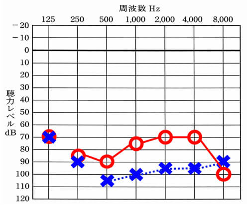 聴力は、両方とも重く、右側の方がまだ良い状態だった。
