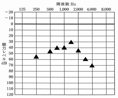 ▲は、補聴器をつけた時の聞こえの数値。この数値が上に行くと上に行くほど、聞こえがよくなっている。