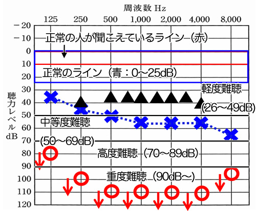 補聴器の改善値と聴力データの数値の意味。補聴器は、聞こえを改善させることはできても、治るというところまでは、残念ながらできない。正常のラインすら、今現在は、厳しい状況。ただ、現状をよくすることはできる。