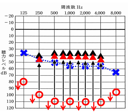 反対側のクロス側の聞こえのイメージは、赤で表現。少し聞こえる耳側よりも下になるが、そもそもの聴力(聞こえ)からすると、大きな改善になる。