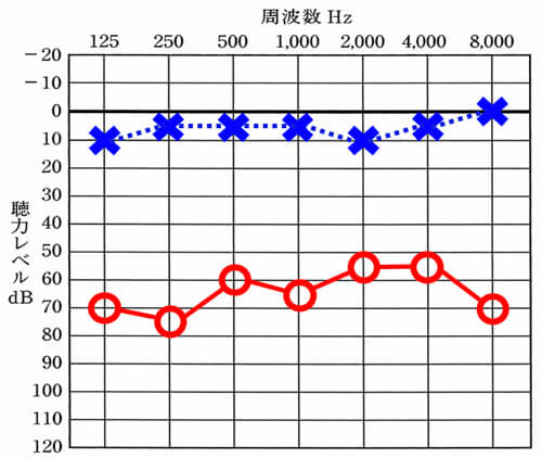 補い方に関しては、聴力によっても異なる。完全に聞こえないレベルまで低下している場合は、補聴器は無理だが、まだ補えるレベル(60〜65dBくらい)は、補聴器での適合例もある。