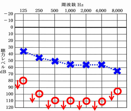 バイクロス補聴器がほぼ無条件で合うのは、このような聴力。聞こえない側は、全然聞こえなく、もう片耳は、少し聞きづらいケース。