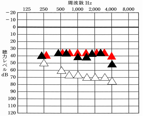 ▲が補聴器あり、赤い▲が、補聴器で聞こえを目指せると良い数値。横に並んでいるものは、目標まで出ており、▲が下にあるものは、足りない状態。この様に確認すると、どこが足りており、どこが足りないかがわかる。そして、チャンネルの数が多いと、その足りていないところだけを補ったりするのがしやすい。