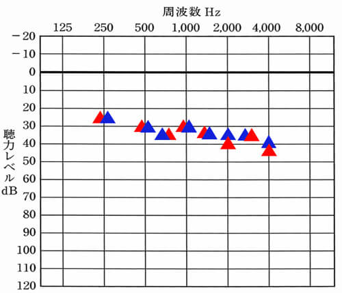 こちらが補聴器使用時の状態を見れる音場閾値測定。赤い▲が右側の補聴器の聞こえで、青い▲が左側の補聴器の状態。この数値がお互いに近いとバランスよく入り、離れている場合は、下にあるものが聞きにくくなる。データの見方は、聴力検査と同じになる。