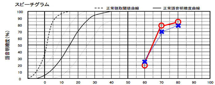 補聴器をつける方は、感音性難聴の方になるため、言葉の聞き取りがどのような状態ないのかを調べる測定もある。それを語音明瞭度測定(語音弁別能検査)と呼ぶ。補聴器は、この測定である程度、数値が行かないと、聞きにくさを感じやすい。感音性難聴ならではの測定になる。