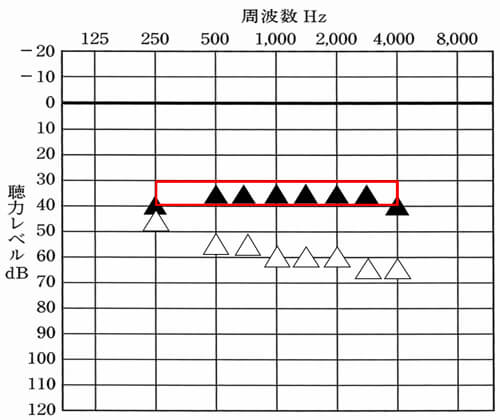 35dBくらいまで改善できると、少し声の小さい方(50dB相当)の声も、小さいながらにも理解しやすくなるため、ここまで改善できると、音声の部分は、聞きやすくなりやすい。