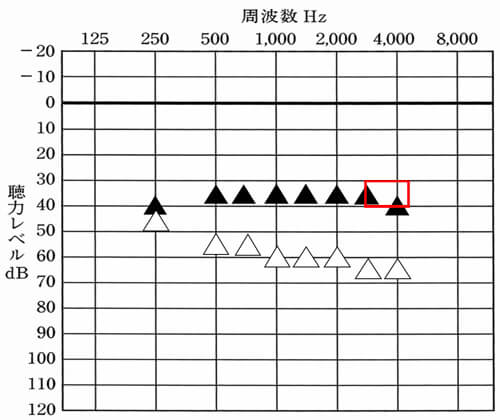 残りは、アラームや一部のお知らせ音で聞こえる高い音の部分。これは、3000Hz、4000Hz以外もあるが、それ以外のものは、音声を聞こえやすくさせるためにあげることが多いため、3000Hzや4000Hzも同じように聞こえるようにさせてあげると、アラーム系もわかりやすくなる。聞こえて気づくようになると、様々なことがわかるようになるので、生活をする上では、この点も重要な部分だ。